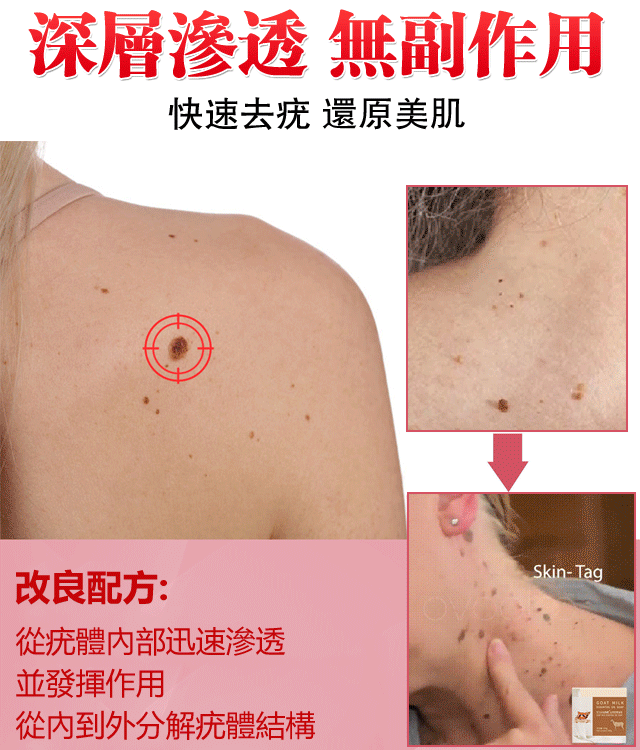 山羊奶去疣精油皂無需手術 衹需一洗輕鬆解决問題